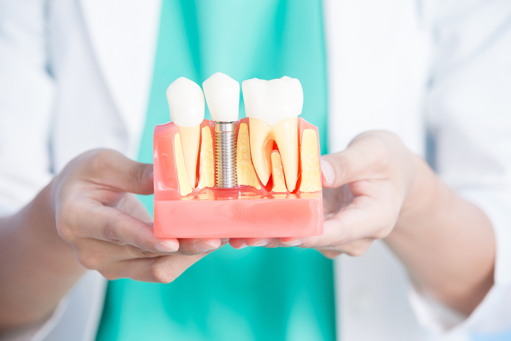 implantacia-zubov.jpg