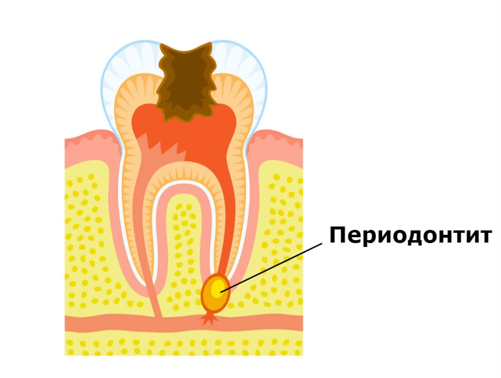 periodontit.jpg